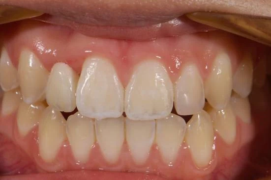 The same anterior segment restored in ceramic — even incisal edges and a matched shade