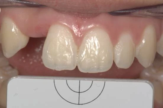 Anterior teeth before treatment — uneven edges, heavy surface staining and mismatched shade