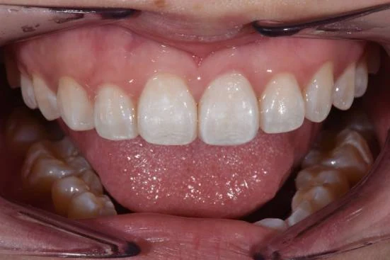 The same teeth restored in ceramic with rebuilt contour and length
