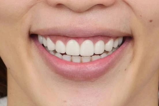 The same smile after ceramic restoration of the upper anterior teeth