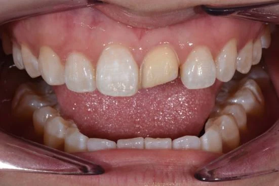 Worn and discoloured upper anterior teeth before treatment
