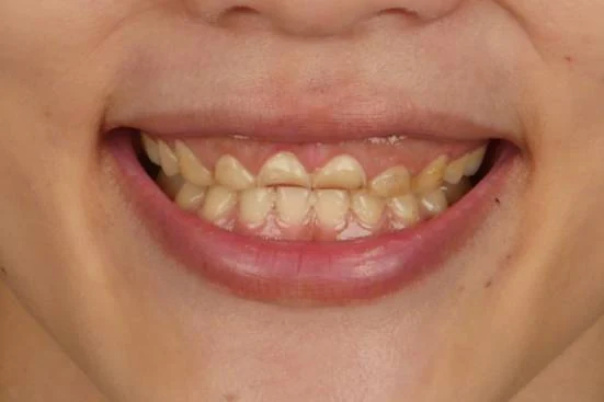 A smile before treatment, with worn and discoloured upper anterior teeth