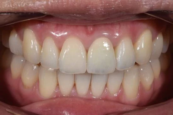 The central incisor restored in ceramic and matched to the adjacent natural tooth