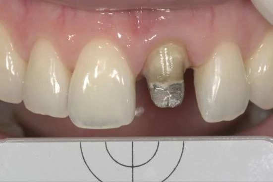 A discoloured central incisor with a failing restoration, beside its natural neighbour