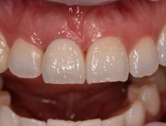 The same segment restored in layered ceramic