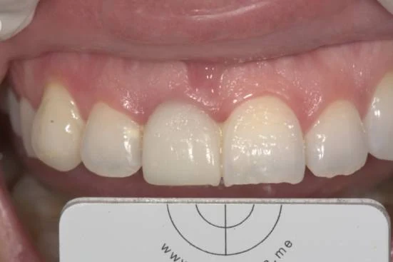 Upper anterior teeth before treatment, showing wear and shade variation