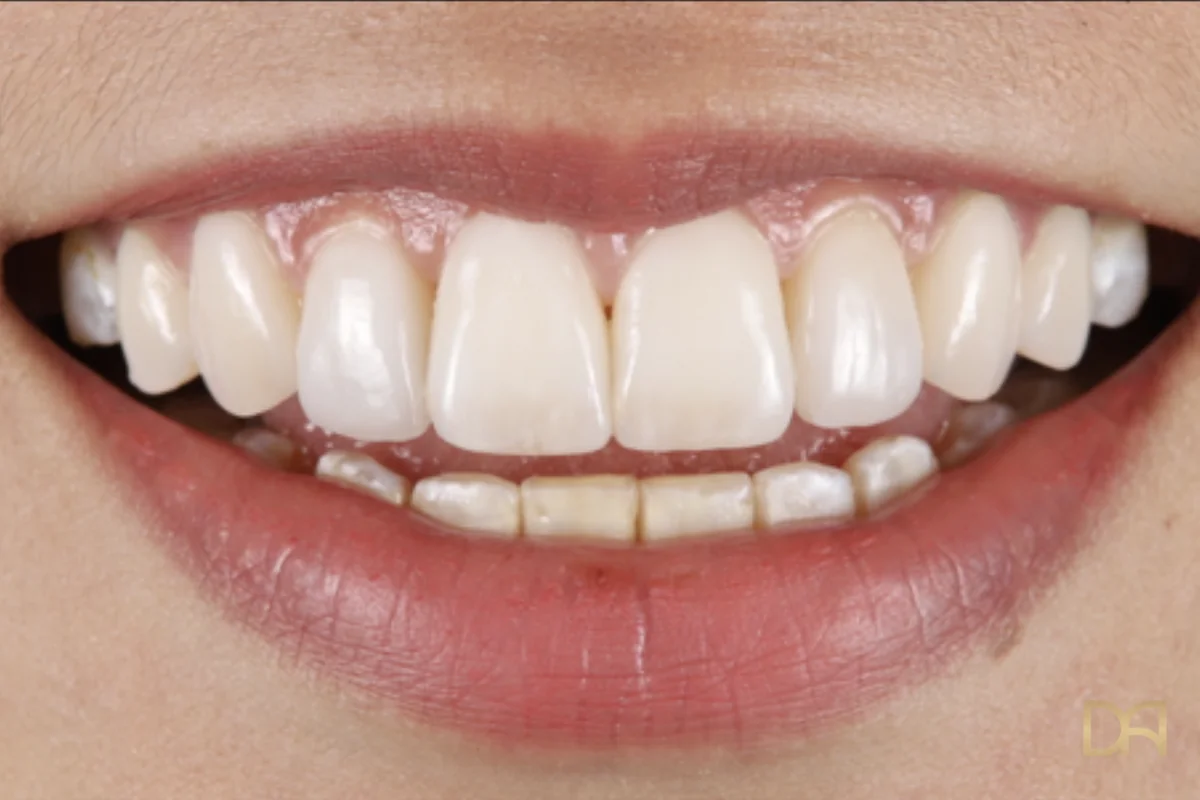 The same smile after ceramic restoration, with an even shade across the upper anteriors