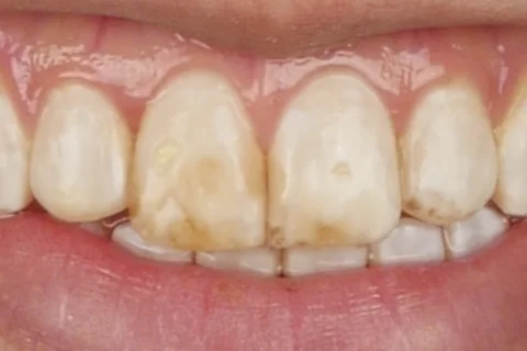 A smile before treatment, with mottled discolouration across the upper anterior teeth