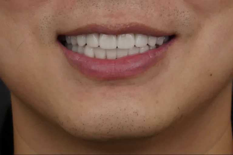 The same face after ceramic restoration of the upper anterior teeth