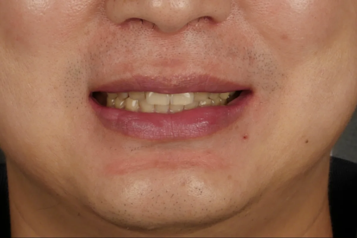 The lower face before treatment, showing worn and discoloured upper anterior teeth