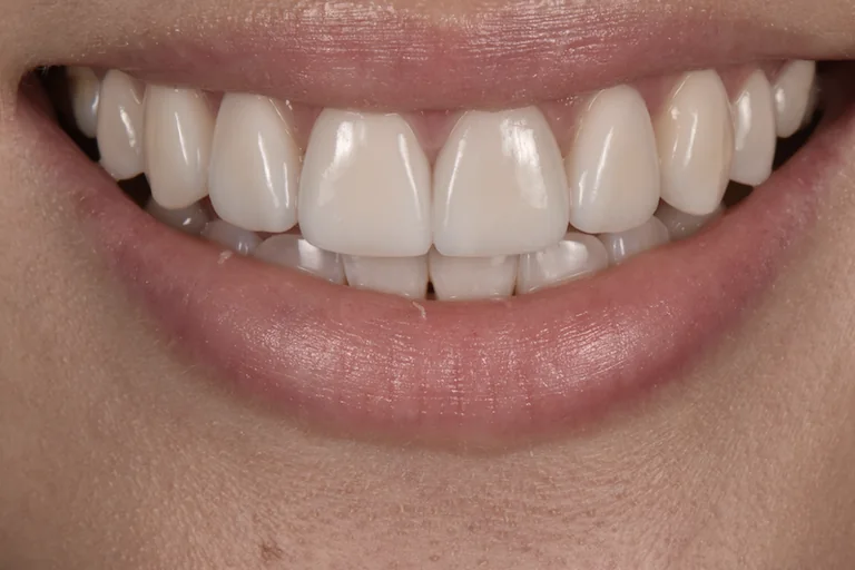 The same teeth after ceramic restoration, with the shade lifted and the edges levelled