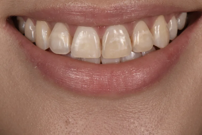 Upper anterior teeth before treatment, greyed and slightly uneven at the incisal edges