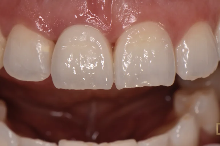 The same lateral incisor restored in ceramic and matched to the teeth beside it