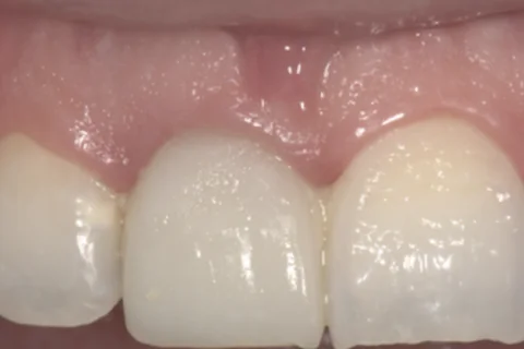 A single discoloured upper lateral incisor beside its natural neighbours