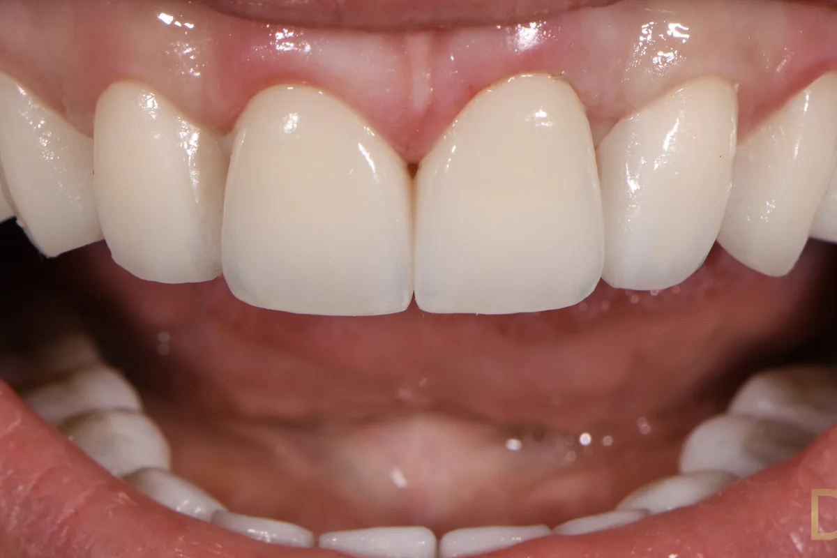 The same upper anterior segment restored in ceramic