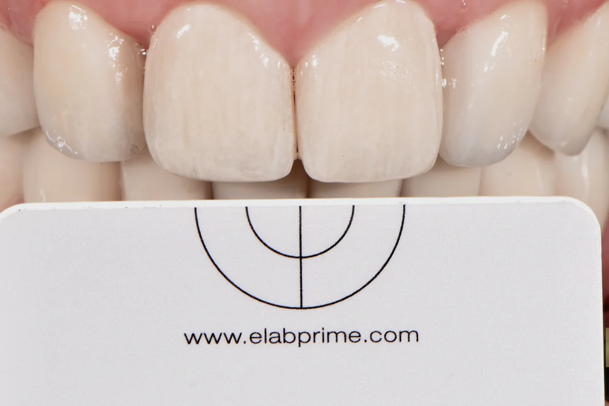 Upper anterior teeth photographed with a calibrated grey shade reference held in frame