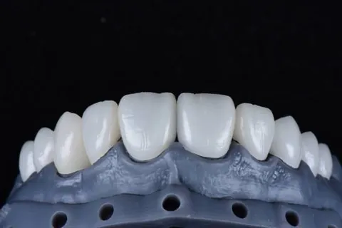 Anterior ceramic bridge on a working model