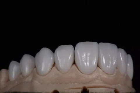 Anterior ceramic restorations seated on a model
