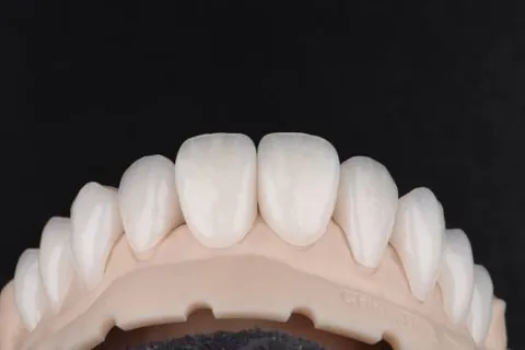 Anterior ceramic units on a stone model