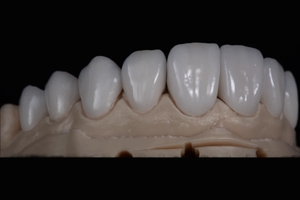 Anterior ceramic units seated on a working model