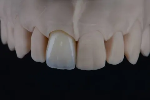 Anterior crown at try-in stage on a model