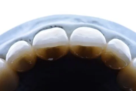 Close view of anterior crown margins on a die