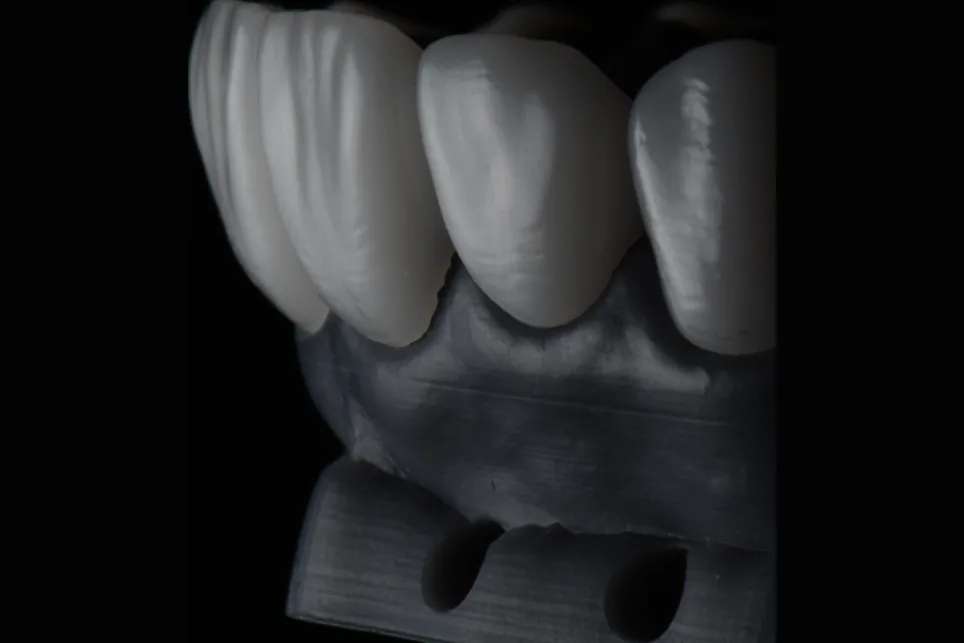 Anterior ceramic units photographed against a dark ground