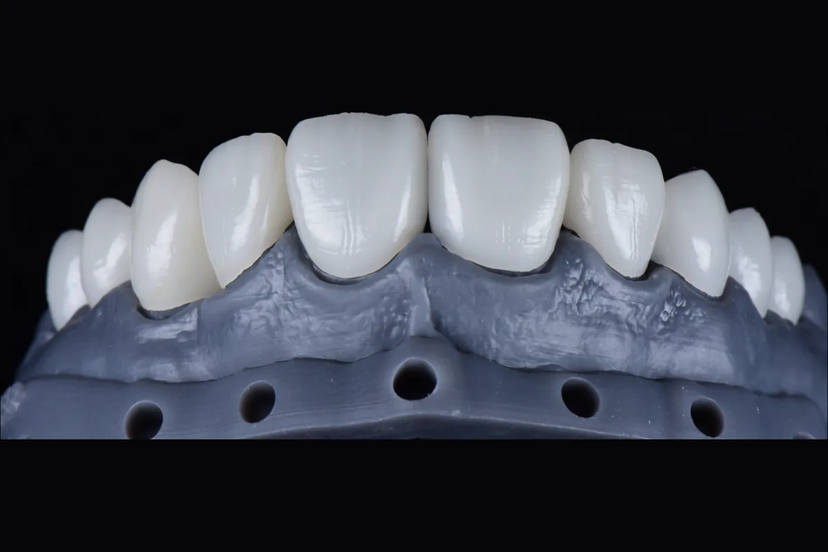 Anterior restorations on a grey model