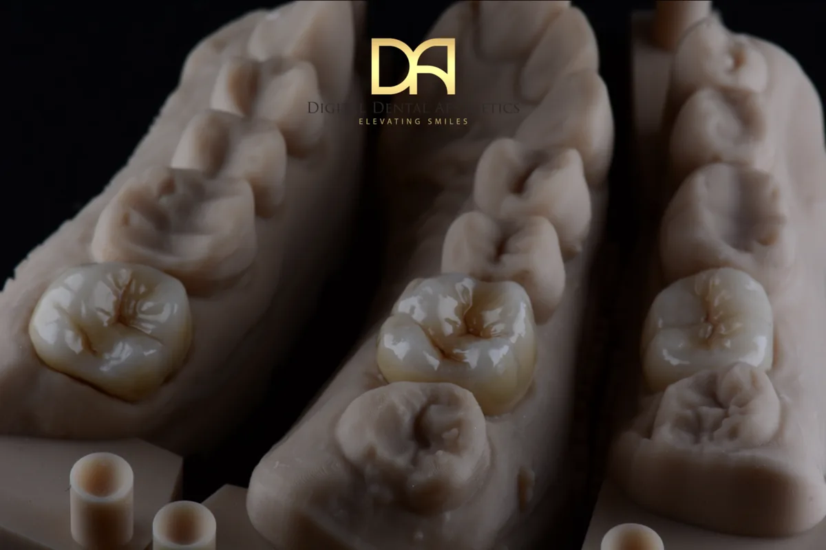 Articulated upper and lower models with posterior restorations in place