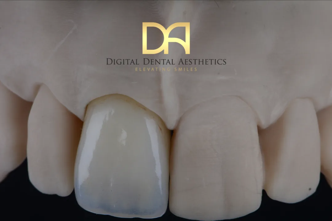 A single central incisor sitting slightly lighter than its neighbours on the model