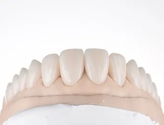 Ceramic veneers seated on a working model, anterior view