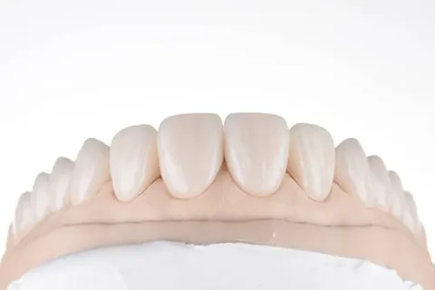 Ceramic veneers photographed for shade assessment