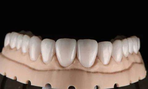 Digital wax-up of anterior teeth on a model