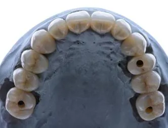 Occlusal view of a full-arch working model
