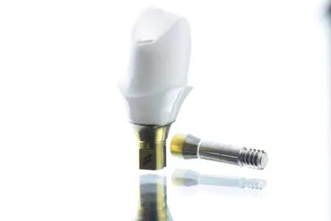 An implant crown seated on its abutment
