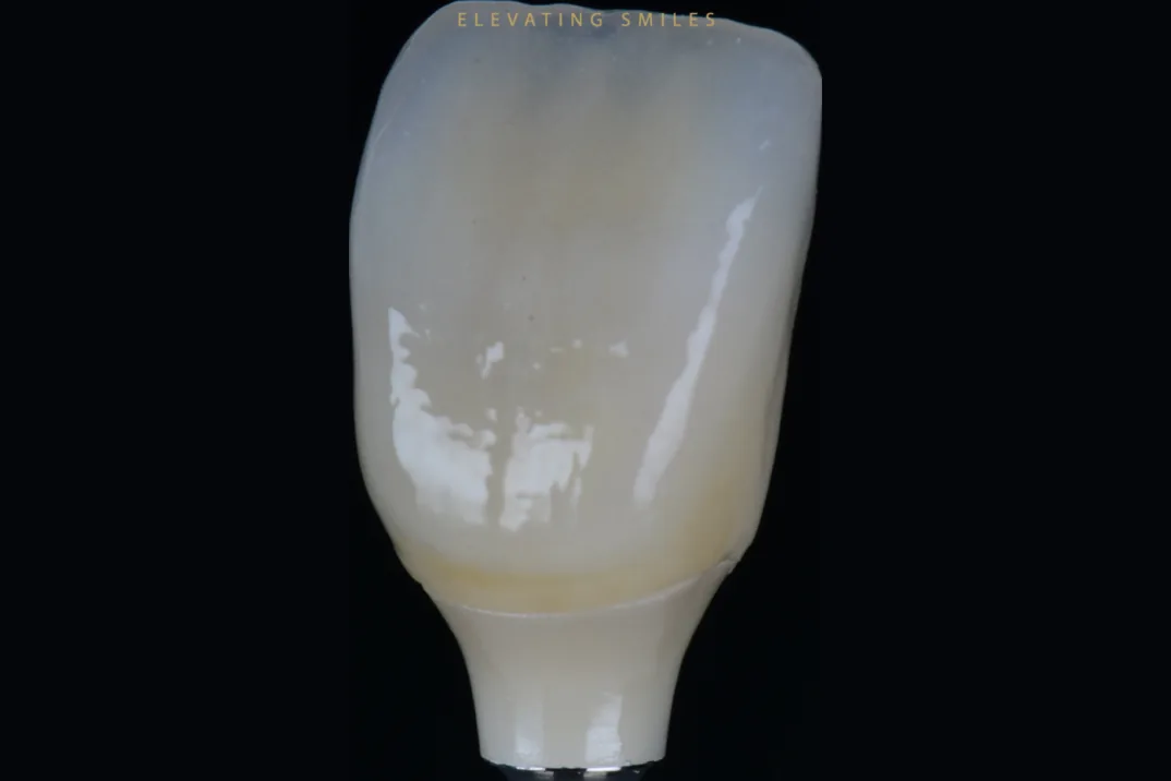 A glazed implant crown on a holder against black