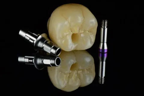 Implant crowns beside their titanium abutments