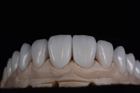 Layered ceramic anterior crowns on a model