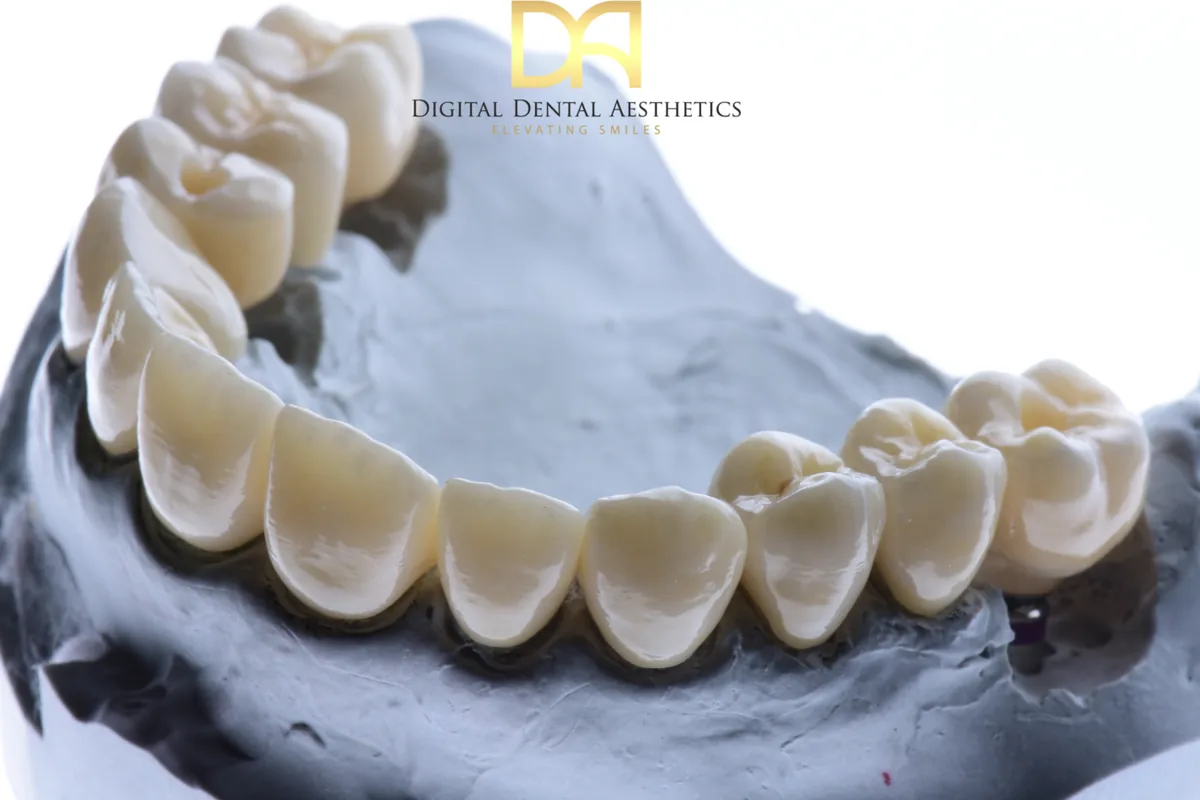 A lower arch of restorations on a stone model, photographed at an angle
