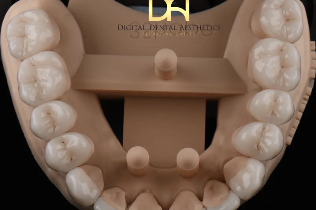 A full lower arch of restorations on the working model, occlusal view