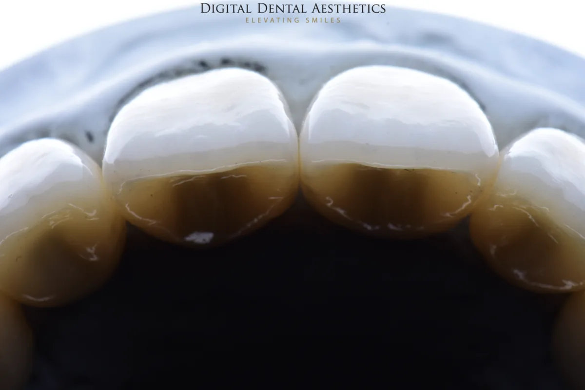 Anterior restorations photographed from the palatal side
