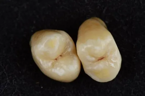 Two posterior ceramic crowns