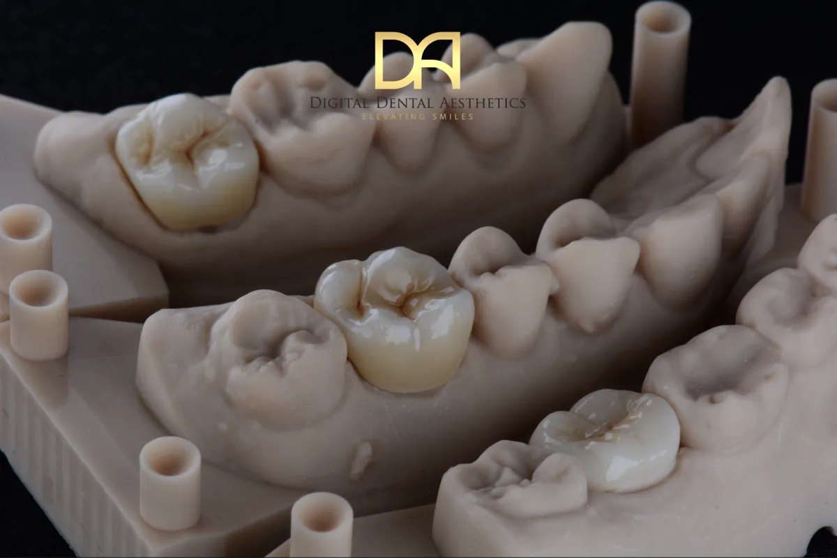Posterior crowns checked in occlusion on the articulated model
