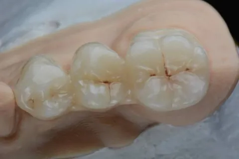 Occlusal detail of posterior ceramic crowns on a model