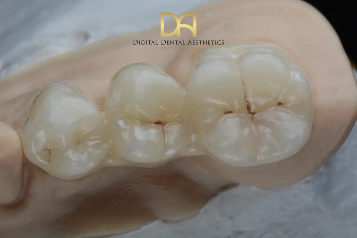 Posterior crowns seated on a working model, occlusal view