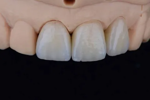 Single anterior crown matched to adjacent natural teeth on a model