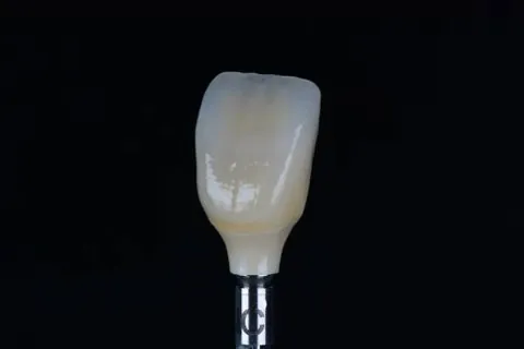 A single finished ceramic crown on a holder