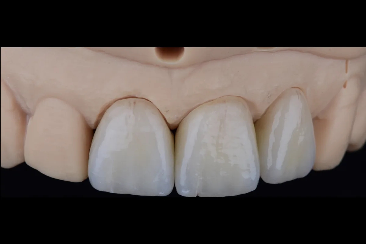 A single anterior unit sitting between two others on the model