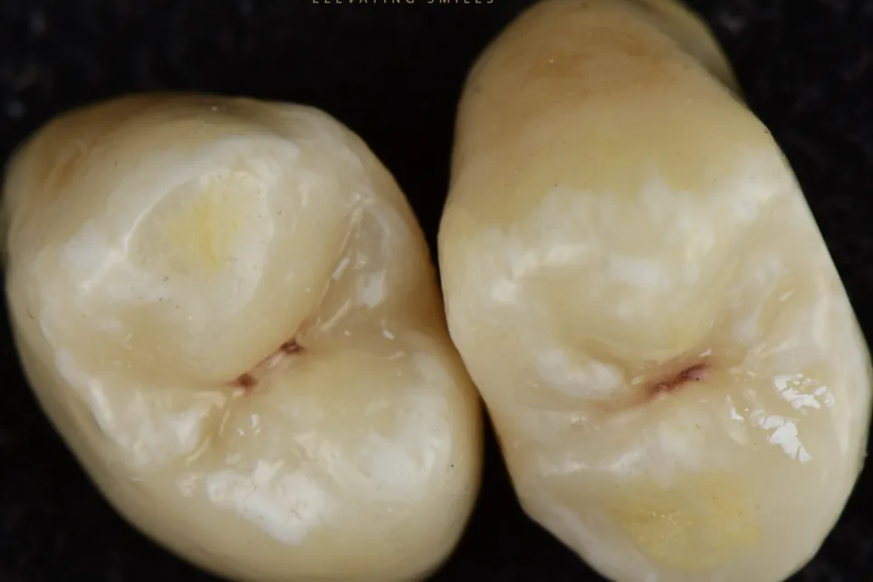 Two posterior crowns photographed off the model against black