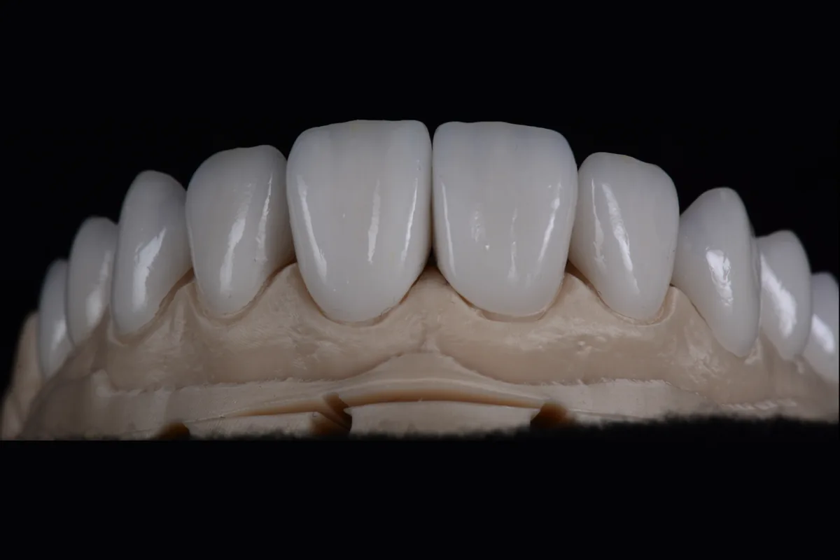 A close view of upper anterior ceramic restorations on the model